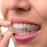 Teeth Aligner Treatment