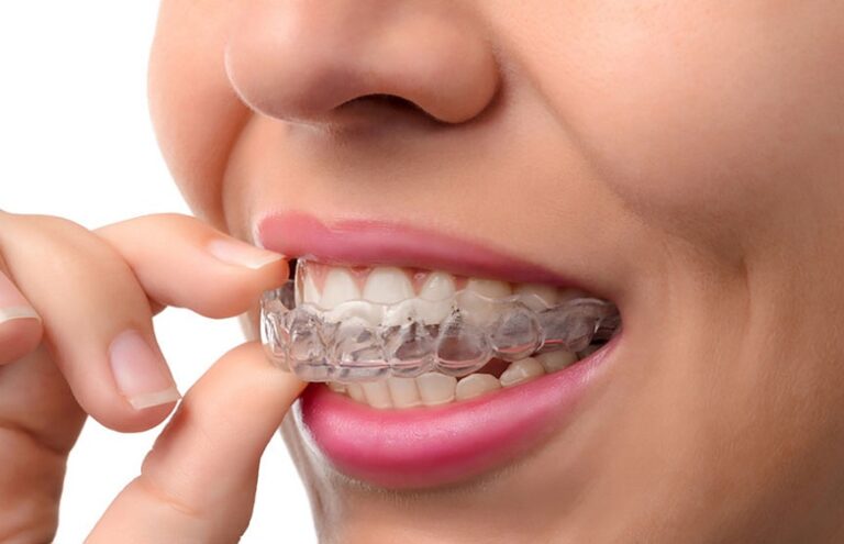 Teeth Aligner Treatment