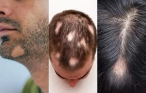 Consider An Alopecia Consultation