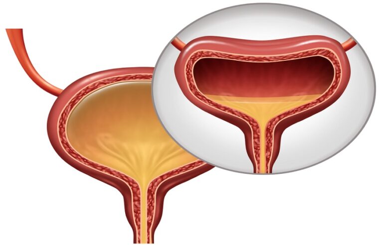 Overactive Bladder