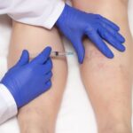 Sclerotherapy Treatment