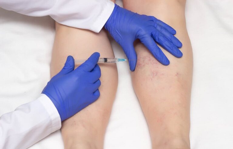 Sclerotherapy Treatment